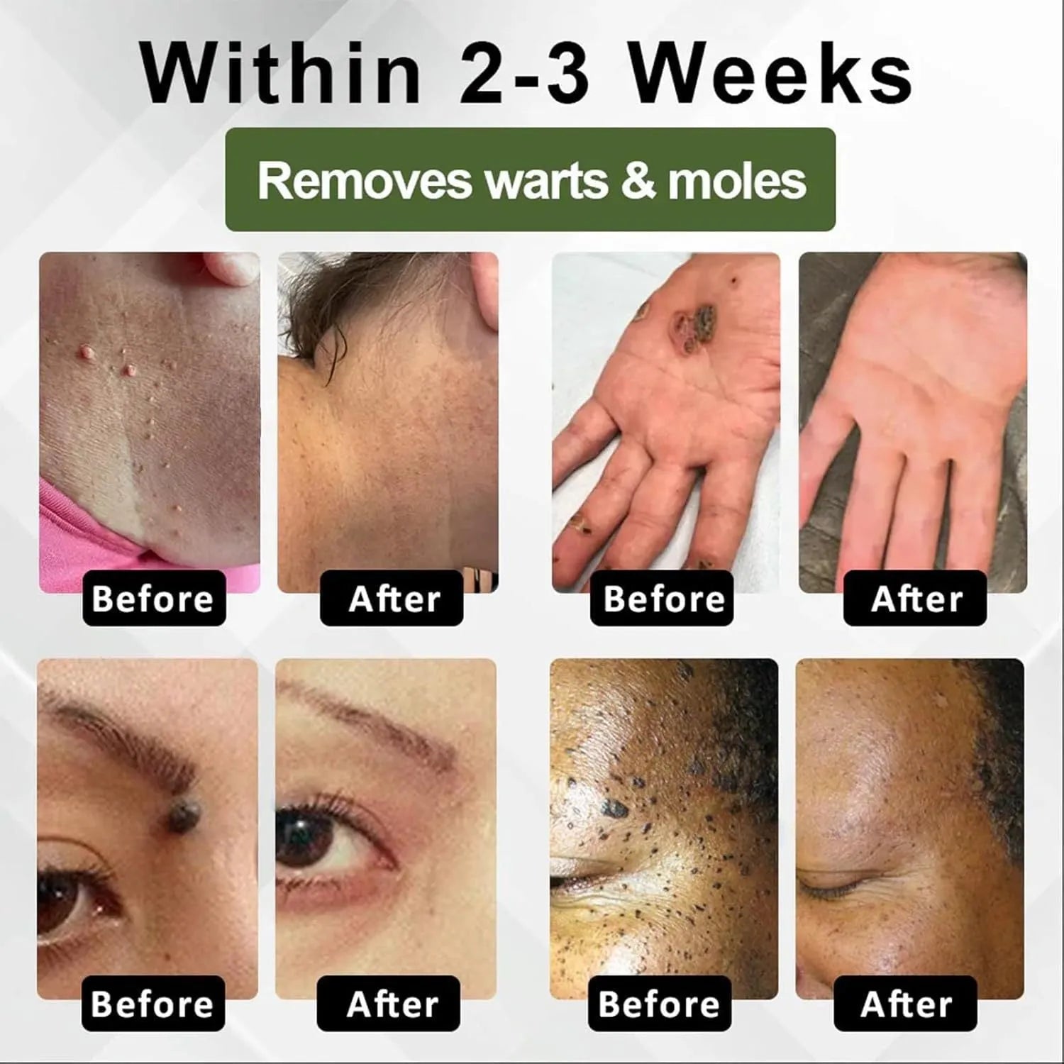 Natureerase Instant Mole Spot Removal Gel 45g tube for hydrating spot treatment