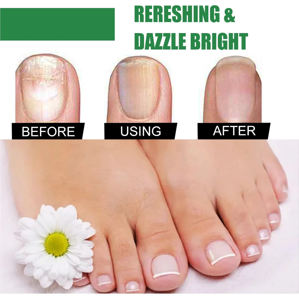 30ml bottle of tea tree oil nail repair treatment fluid for fingernails and toenails.