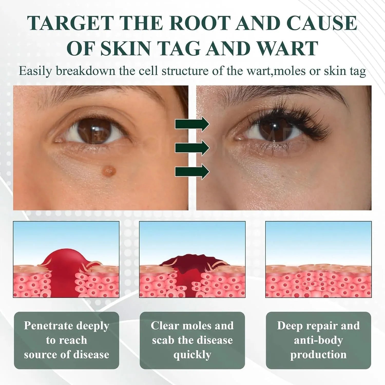 Natureerase Instant Mole Spot Removal Gel 45g tube for hydrating spot treatment
