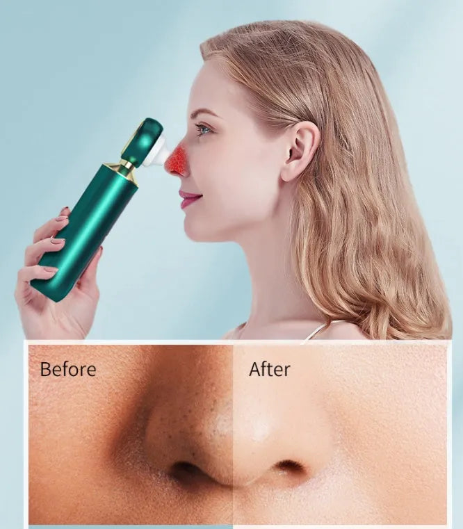 Portable visual blackhead meter with convex lens, LED light, and three suction tips in white colour option